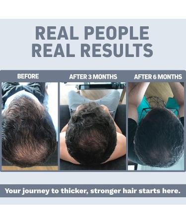 Herbtonics Multi Collagen Gummies Type 1 2 3 5 & 10 with Biotin for Hair Growth Skin Nails - Foli-Tonic DHT Blocker & Hair Loss Supplement | Hair Thinning Treatment & Promotes Healthy Thicker Hair - Buy Online on GoSupps.com