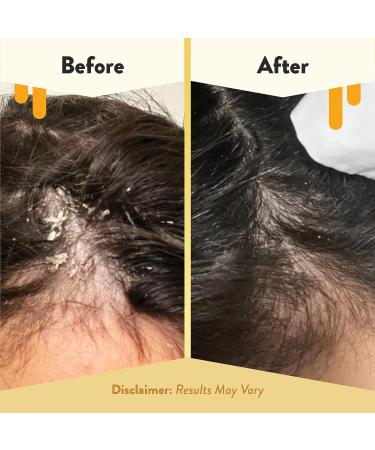 ECZEMA HONEY Soothing Scalp Oil - Natural Hair & Scalp Treatment (1 Oz) - Buy Online on GoSupps.com