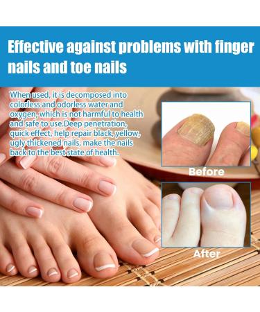 DFVGC Foot care spray supports an improved foot climate foot spray foot treatment cares for skin and nails athletes foot treatment protective spray for nail and foot care 2 pieces one 2 pieces 50 ml 2er Pack - Buy Online on GoSupps.com