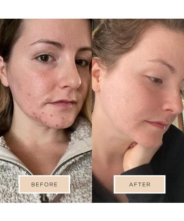 Averr Aglow Luminous Clear Skin Kit - Hydrating Cleanser & Acne Care Set for Breakouts & Dark Spots (5PC) - International Shipping Available - Buy Online on GoSupps.com