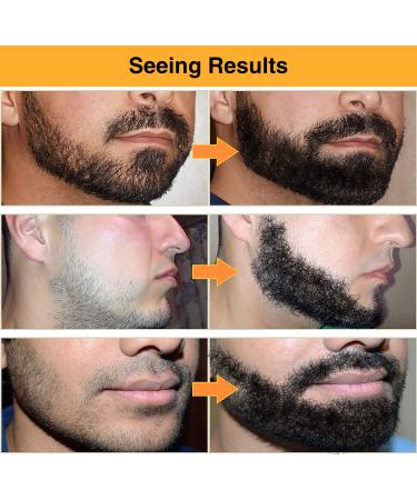MISICH Beard Derma Roller for Men - 540 Titanium Microneedle Daily Use Beard Roller Black - Buy Online on GoSupps.com