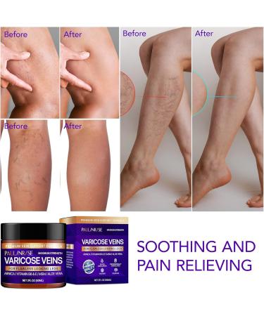 PAULINRISE Varicose Veins Cream - Natural Treatment for Pain Relief - Buy Online on GoSupps.com