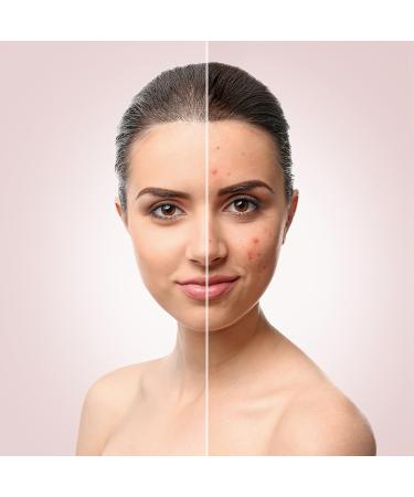 Porygon Beauty Blackhead Remover Kit - Stainless Steel Acne Extractor Tool Set for Face Blemish Extraction - Buy Online on GoSupps.com