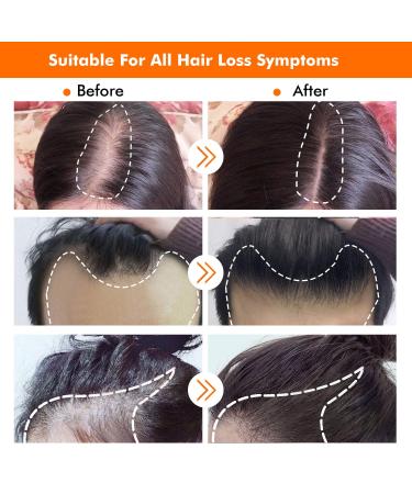 Derma Roller & Hair Growth Serum Combo with Scalp Massager for Maximum Absorption - Buy Online on GoSupps.com