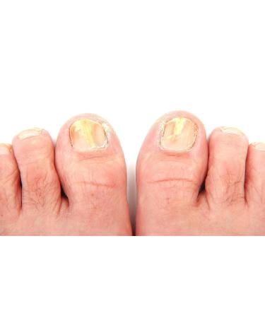 VIT 20 Antifungal Brush-on 0.5 oz - Fast-Acting Treatment for Fungal Infections - Buy Online on GoSupps.com