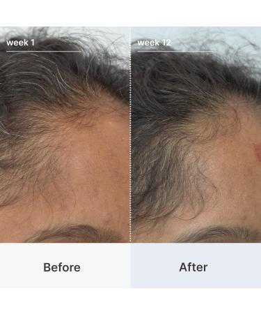 Buy Superpower Thickening Hairpatches - Boost Volume & Confidence | International Shipping Available - Buy Online on GoSupps.com