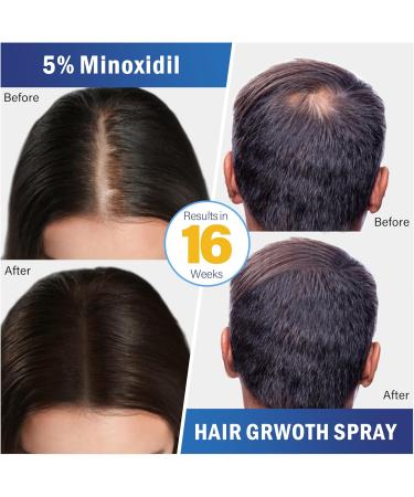 5% Minoxidil Hair growth Spray for Women and Men: Anti Hair Loss Treatment for Hair Regrowth Extra Strength Scalp Solution Thicken Strengthen Longer Hair 100Ml - Buy Online on GoSupps.com