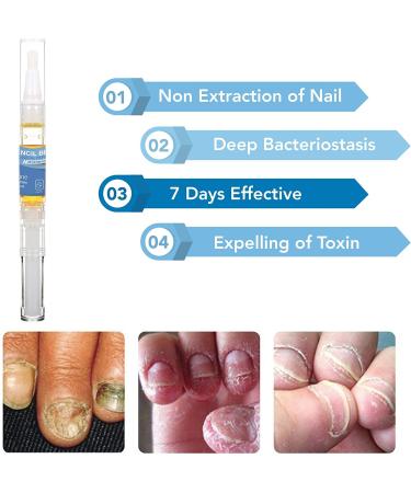 Arishine Fungus Stop Treatment - 2 Pack Nail Solution for Effective Anti Fungal Treatment of Toenails and Fingernails - Buy Online on GoSupps.com