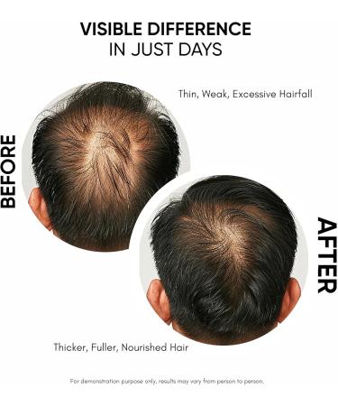 S rum de croissance des cheveux pour favoriser la croissance des cheveux et contr ler la chute des cheveux avec 3 % Redensyl 5 % Capixyl 4 % Anagain 3 % Procapil 3 % Baicapil romarin et - Buy Online on GoSupps.com