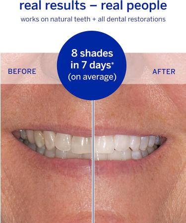 Dissolving Superstrips by Supersmile - Enamel Safe Professional Teeth Whitening Strips for Sensitive Teeth - Fast International Shipping - Buy Online on GoSupps.com