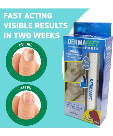 Med-Fit Dermafeet Nail Pen for Discolored and Yellow Nails - Easy Nail Stain Removal and restore your nail to its natural colour - Buy Online on GoSupps.com