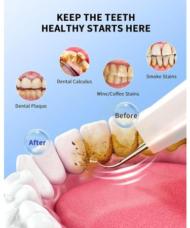 Electric Tartar Remover with Camera - Teeth Whitening Kit - 1080P HD Waterproof Camera - iOS & Android Compatible - Buy Online on GoSupps.com