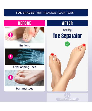 Effective Toe Separator & Stretcher for Bunions, Hammertoes & Crooked Toes | Universal Size, Latex-Free & PVC-Free - Buy Online on GoSupps.com