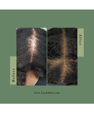 Yayda Hair Growth Oil - Natural & Vegan Hair Growth Serum with Rosemary Green Coffee Lavender | Fights Hair Loss Reduces Thinning DHT Blocker | Best Solution for Hair Regrowth - Buy Online on GoSupps.com