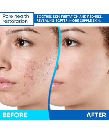 AOBBIY Azelaic Acid Cream: Azelaic Acid For Face - Premium Azelaic Acid Cream - Face Skin and Beauty Care - Azelaic Acid Facial Cream (1 Oz) - Buy Online on GoSupps.com