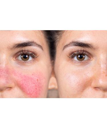 Organic Essential Oils for Rosacea Relief - 28-Day Dual Stage Treatment - Buy Online on GoSupps.com