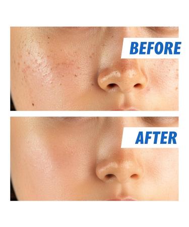 Nightingale Ecto-Hyaluronic Ampoule - 8 Layer Hyaluronic Acid Serum for Dry Skin | Fragrance Free Hypoallergenic Vegan Korean Skin Care - Buy Online on GoSupps.com