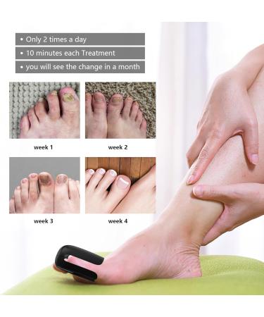 Nail Fungus Treatment for Toenails Light Therapy Fungus Highly Effective Cleaning Device 470 nm&660 nm Rechargeable Fungus Treatment for Fingernails and Onychomycosis Home Use (black) - Buy Online on GoSupps.com