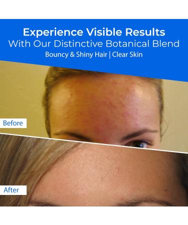 CLEAR 2 PERFECTION Acne Treatment Kit | Non-Comedogenic Haircare & Skincare Trio for Acne-Prone Skin & Bacne - Scrub Shampoo & Conditioner - Buy Online on GoSupps.com