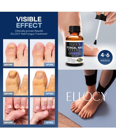 Extra Strength Toenail Fungus Treatment - Repair Damaged Nails | 30ml Nail Repair Liquid - Buy Online on GoSupps.com