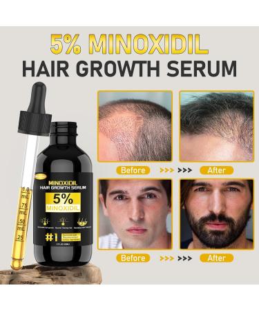 5% Minoxidil Hair Regrowth Treatment - Thicker Fuller Hair for Men & Women | 60ML/2OZ - International Shipping Available - Buy Online on GoSupps.com
