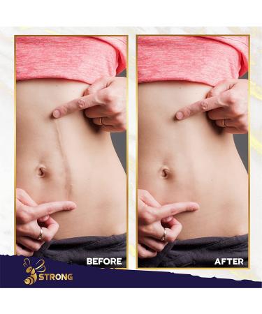Natural Scar Removal Cream for Surgical, Acne, Cuts, Burns & Stretch Marks - Skin Renewal Support for Women & Men - All Skin Types - Buy Online on GoSupps.com