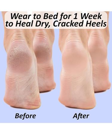 Moisturizing Socks for Cracked Heels - Spa Gel Silicone Toeless Socks for Dry Feet Repair | 1 Piece Set for Women - Buy Online on GoSupps.com