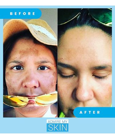 Dark Spot Corrector Set: Brightening Serum + Retinoid Cream + Vitamin C Oil - Target Dark Spots & Uneven Skin Tone with this Ultimate Facial Regimen - Buy Online on GoSupps.com