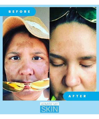 Admire My Skin Dark Spot Corrector Serum + Retinoid Cream Set - Buy Online on GoSupps.com