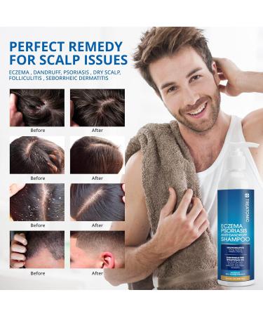 Best Eczema & Psoriasis Shampoo | Seborrheic Dermatitis & Scalp Treatment - International Shipping - Buy Online on GoSupps.com