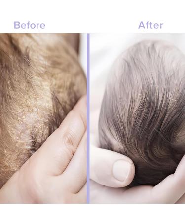 Buy Bee Nature Baby Shampoo Bio - Milk Crust Treatment 99% Tear-Free Honey Mousse for Newborns & Kids - 200ml - Sensitive Scalp Care - Buy Online on GoSupps.com