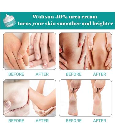 Waltsun Urea Cream 40% - Callus Remover for Dry Cracked Skin, Exfoliation & Moisturizing for Soft Feet, Elbows, Knees, and Hands - Buy Online on GoSupps.com
