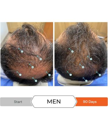 Hair Thinning & Hair Growth Kit w/Revita Hair Stimulating Shampoo and Revita Hair Growth Supplement Tablets for Men & Women (All Types of Hair Loss) - Buy Online on GoSupps.com