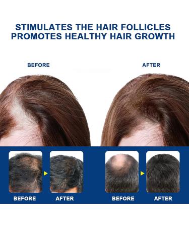  G n rique Baldness Cream - 20g Hair Growth Oil for Fast-Acting Effective Use Anti-Alopecia with High Hairline Solution Hairless Baldhead Hair Development Moisturizer for Men Women Thinning - Buy Online on GoSupps.com