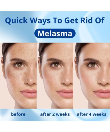 ABERA Retinol Serum Best Melasma Treatment For Face Niacinamide & Vitamin A Anti Aging Serum Remove Freckles Wrinkles & Dark Spots Brightening Serum for Glowing Skin (Set 3) - Buy Online on GoSupps.com