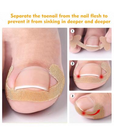 Xinzan 2 Types Ingrown Toenail Treatment Patch with Ingrown Toenail Tool Professional Ingrown Toenail Corrector Tools for Toenail Care Protect Toe Nail - Buy Online on GoSupps.com