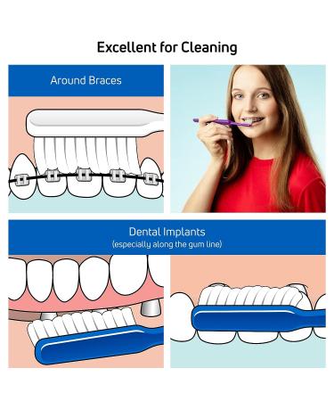 TEPE Implant Orthodontic Soft Toothbrush | Extra Narrow Brush Head | Thin Neck | 1 Pack - Buy Online on GoSupps.com