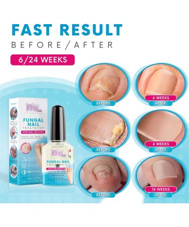 Fungal Nail Treatment for Feet and Hands 12 ml - Professional Made in Italy Strong Toenail Fungus Treatment Prevents Nail Fungus and Restores the Natural Appearance of the Nail. - Buy Online on GoSupps.com