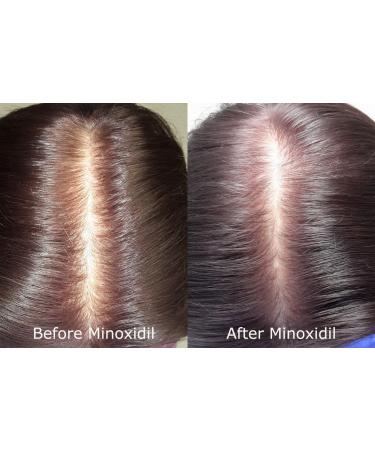 Rogaine Men Foam Unscented 2.11 Ounce 4-Pack - Hair Regrowth Treatment - Buy Online on GoSupps.com