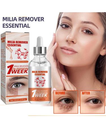 KOAHDE Milia Removal Face Serums Milia Spot Treatment Milia Treatment Spot Remover for Face Speedy Milia Remover Milia Spot Ruduce Face Serums Dark Spot Remover Face Serum Milia Removal Spot Care - Buy Online on GoSupps.com