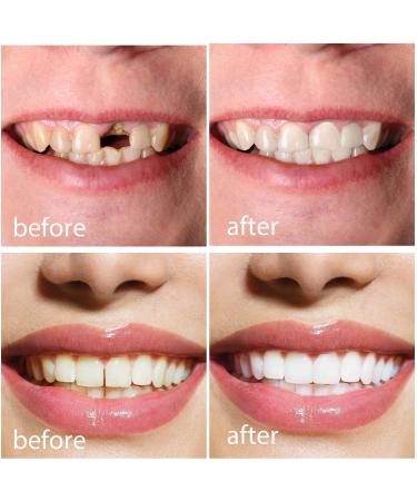 Provisional Tooth Repair Set | Formable False Teeth & Thermal Adaptation - International Shipping Available - Buy Online on GoSupps.com