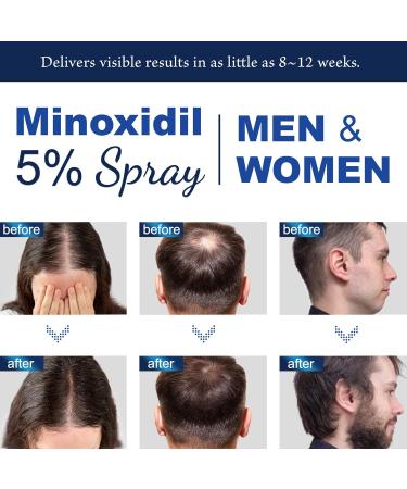 Hair & Beard Growth Serum Spray - 5% Minoxidil Hair Loss Treatment for Men & Women | Effective Hair Regrowth Solution - Buy Online on GoSupps.com