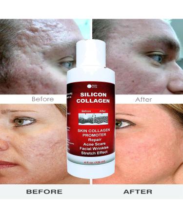 ALKA VITA Silicon & Collagen Gel for Indented Facial Scars - Skin Resurfacing & Collagen Promotion - Buy Online on GoSupps.com