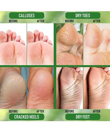 PurOrganica Urea 40% Foot Cream - Callus Remover for Thick, Cracked Skin - Moisturizes & Rehydrates - Made in USA - 1 Pack - Buy Online on GoSupps.com