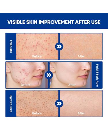Folliculitis & Acne Treatment Cream Salicylic Acid & Herbal Extracts for Scalp Face Body & Back Soothes Irritated Skin Redness & Itch Relief 100g (Pack of 1) 3.4 Fl Oz (Pack of 1) - Buy Online on GoSupps.com