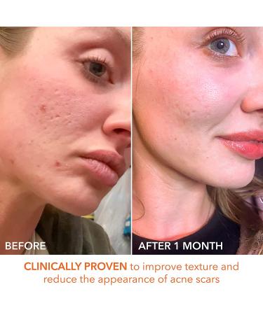 Dr. Dennis Gross Alpha Beta Extra Strength Daily Peel for Oily Skin - 60 Treatments | Targets Uneven Tone, Texture, Wrinkles & Pores - Buy Online on GoSupps.com