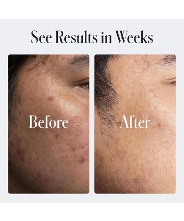 Geologie Skin Repair Moisturizer Face Cream | Clear System Retinol Resurfacing Formula | For Blemish Prone Skin with Niacinamide & Hyaluronic Acid | 60 ML - Buy Online on GoSupps.com