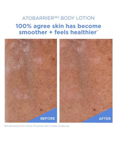 AESTURA ATOBARRIER365 Korean Body Lotion with Ceramides | Fast-Absorbing Moisturizer for Dry Sensitive & Eczema-Prone Skin | Non-Comedogenic Fragrance-Free 400 mL / 13.5 fl oz - Buy Online on GoSupps.com