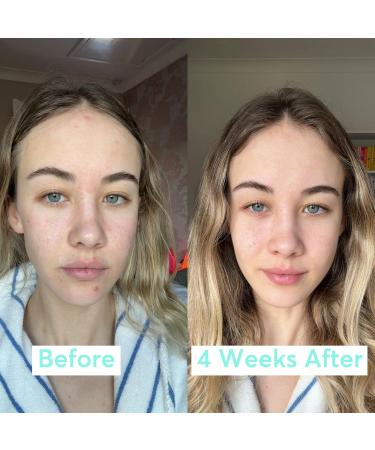 Super Facialist Breakout Buster Serum - Clear Skin Solutions Spot Treatment for Acne with 10% Niacinamide Tea Tree Oil & Prebiotics Vegan Friendly 30ml - Buy Online on GoSupps.com