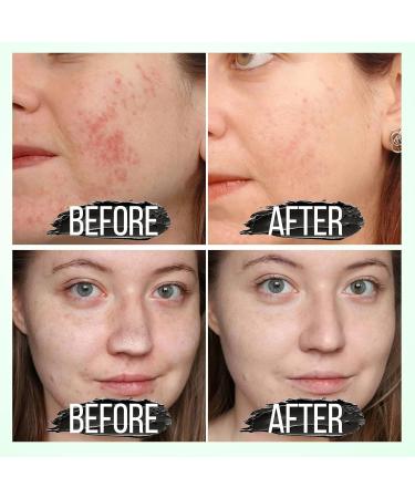 Black Head Remover | Peel Off Charcoal Mask for Deep Cleansing Pores | Acne Treatment for Men & Women - Buy Online on GoSupps.com